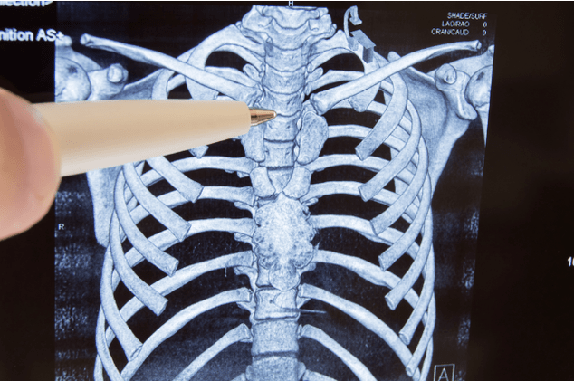 Osteochondrosis