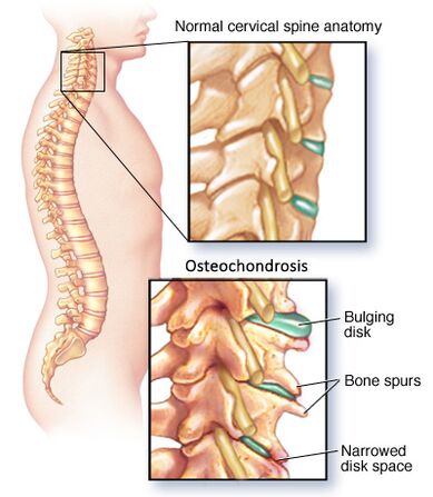 Cervikální osteochondrosis