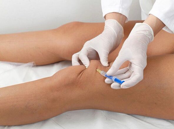 intraartikulární injekce pro kolenní artrózu