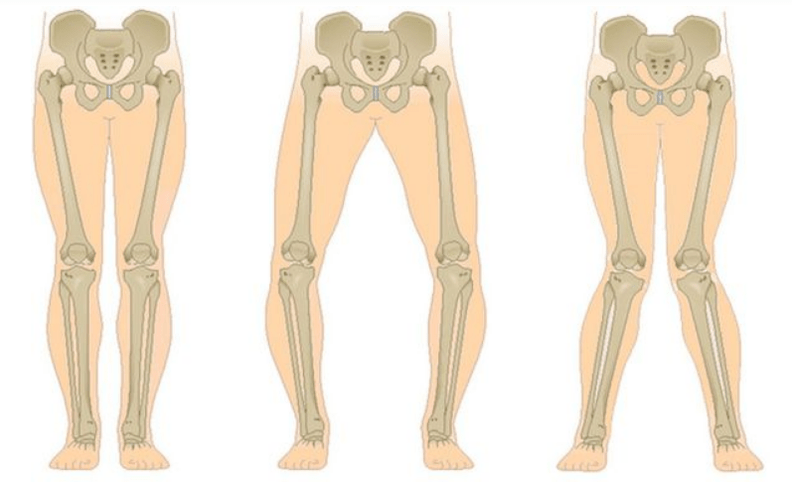 komplikace kolenní artrózy